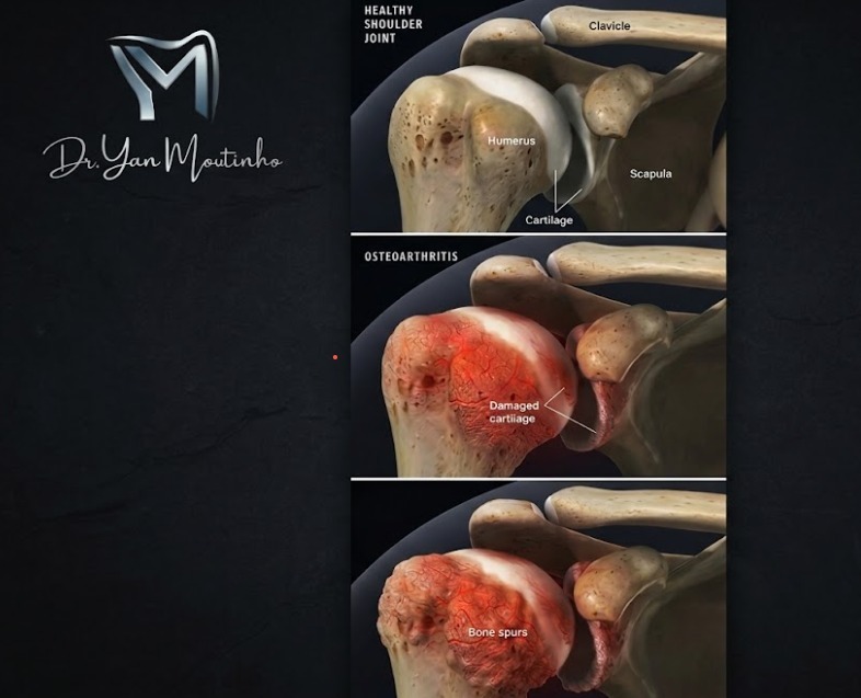 Infográfico comparando ombro saudável, artrose com desgaste da cartilagem e formação de osteófitos