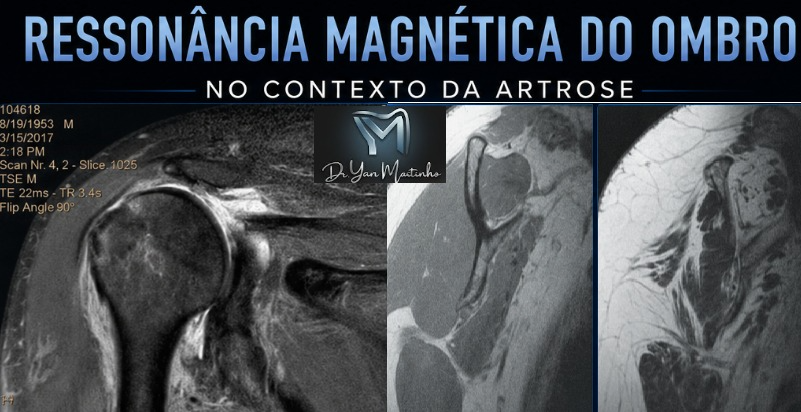 Ressonância Magnética no contexto da artrose de ombro
