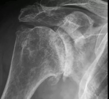 Radiografia de Artrose Avançada