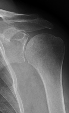 Radiografia de Ombro Normal