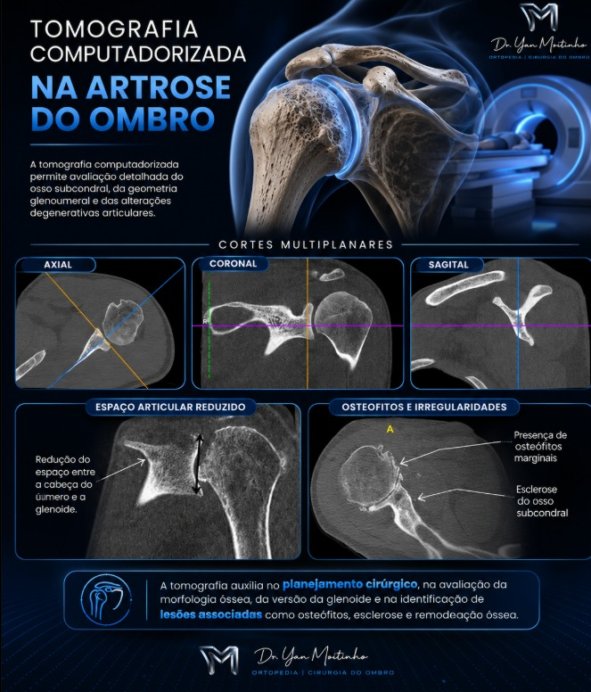 Tomografia Computadorizada para Planejamento Cirúrgico