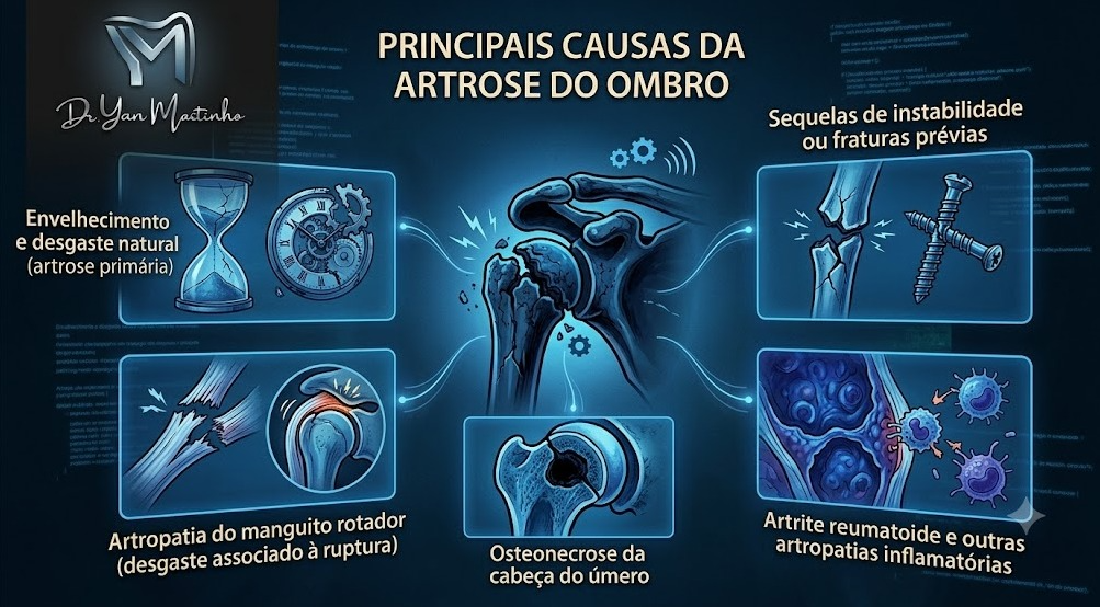 Principais Causas da Artrose do Ombro