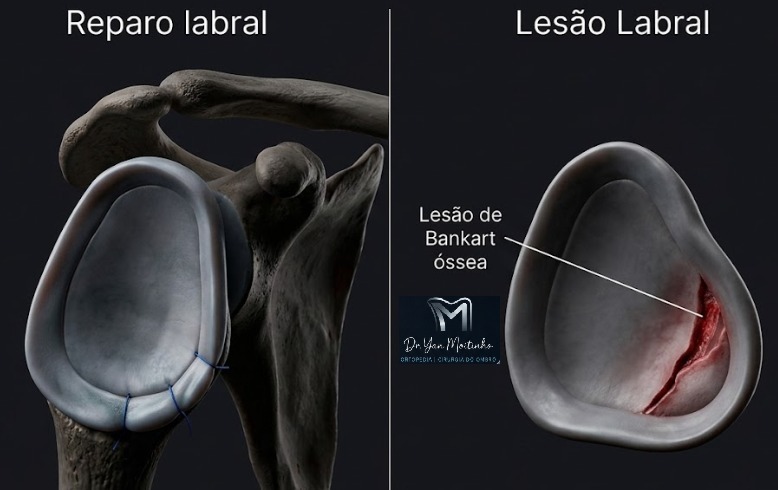 Lesão Labral de Bankart e Reparo