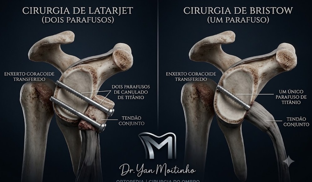 Cirurgias de Latarjet e Bristow