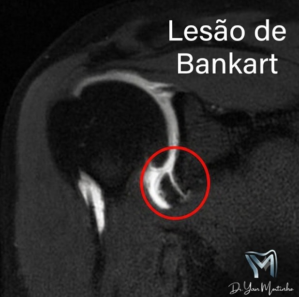 Lesão de Bankart na Ressonância Magnética