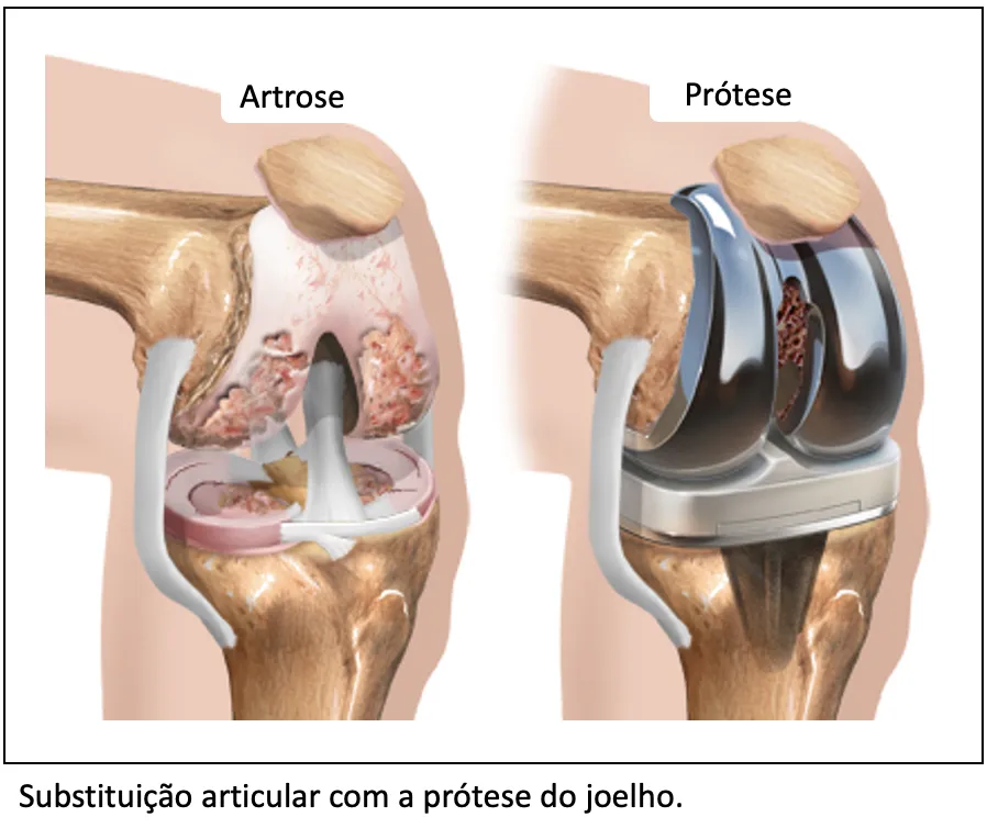 Próteses Articulares