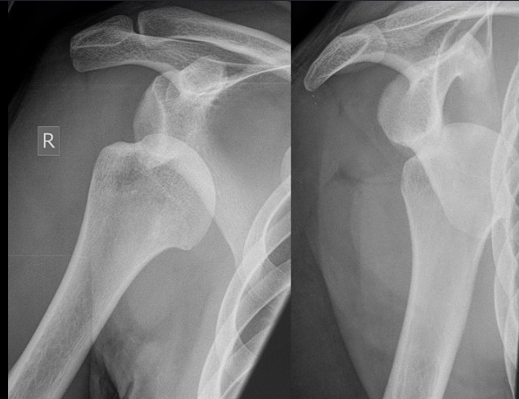 Radiografia de Ombro Luxado