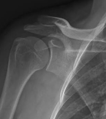 Radiografia de Ombro Normal