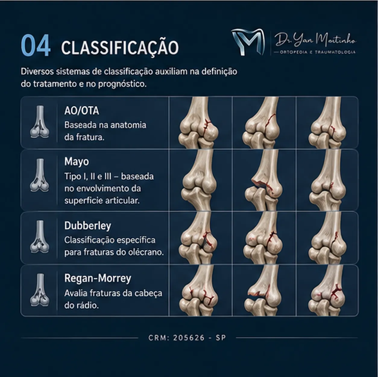 Classificação Clínica de Kellgren-Lawrence